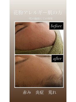 オーブ(Aube)/【20代　お客様before after】