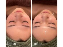 ピュアリーヴィヴィ(Purely ViVi)/REVI 陶肌トリートメント60分