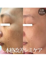 アンク(Ankh)/本格改善シミケア