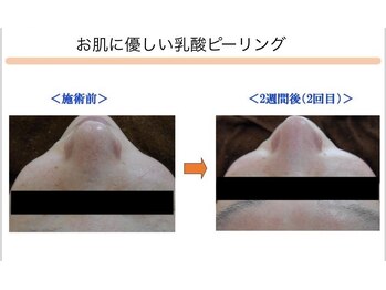 ベッラドンナ(Bella donna)/毛穴詰まり BeforeAfter