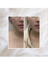 プリマプリート 名駅店/脂肪分解セラム×水玉LDMリフト