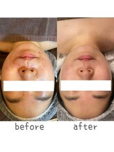 トモズサロン28(Tomos.salon.)/繰り返す肌荒れにアプローチ！