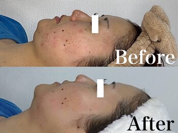 ソフィーム/２回フェイシャルビフォアフター