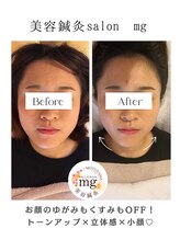 ミリグラム(mg)/【美容鍼灸６０分】