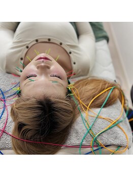 フラット(flat)/施術風景/小顔美容鍼