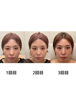 シエル(Ciel)/回数のたびに小顔に！