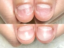 グレースレディ/矯正が終わり、深爪予防に移行