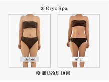 クリオスパ せんげん台駅前店(Cryo Spa)/脂肪冷却Before/After