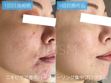アクネラボ 梅田店(ACNE LABO)の雰囲気（ニキビケア！肌荒れ、毛穴もオールクリアに）