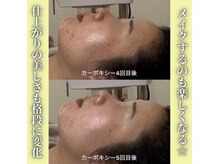 ハニエル(Haniel)/カーボキシー症例