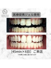 ラクナ ホワイトニング(RAKUNA)/歯科医提携ホワイトニング症例