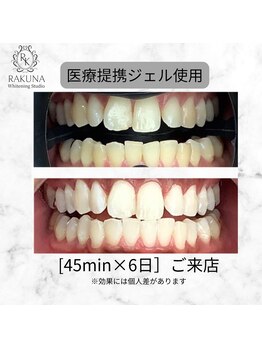 ラクナ ホワイトニング(RAKUNA)/歯科医提携ホワイトニング症例