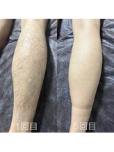 カナウ(KANAU)/脚脱毛（20代前半男性）