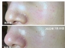 ミントの雰囲気（夏の紫外線で老け見えする前に始める美肌ケア◎水光肌/韓国肌）