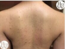 ハーバリー ハーブピーリング 金山店(HERBERRYハーブピーリング)/自分では気づきにくい【背中】