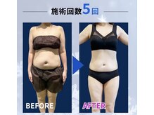 縁(en)/脂肪冷却＊ビフォーアフター