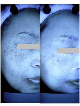 プリマジュール/隠れシミに働きかける！