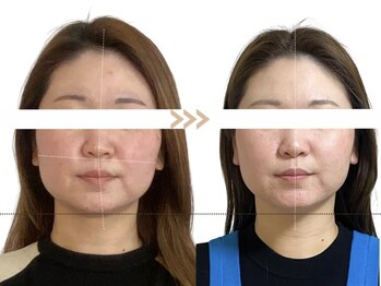 メラリノ(Melalino)/シンメトリー小顔×内臓整美SET