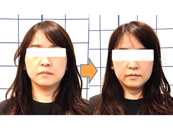 幸葉/小顔矯正1回目でここまで変化★