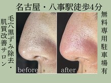 ティーツリー 名古屋 桜山(Tea Tree)/毛穴黒ずみ除去専門店