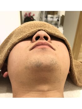 レヴィオ(REVIO)/髭脱毛