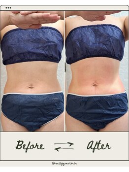 リアウェイク(Reawayke)/脂肪冷却