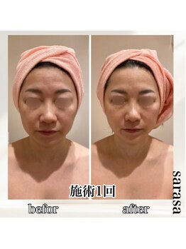 ナチュラル ビューティー スタイル さらさ(Natural Beauty Style)/フェイシャル施術1回