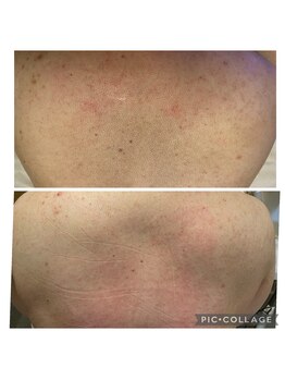 リリーココ(Lily Coco)/背中の埋もれ毛