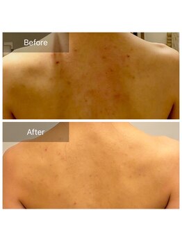 リバース(Rebirth)/背中のニキビケア