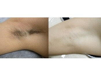 パウザ(PAUSA)/美療脱毛（男性わき）