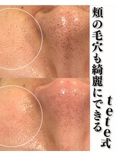 ミリ(MiLi)/頬もエクストラクション