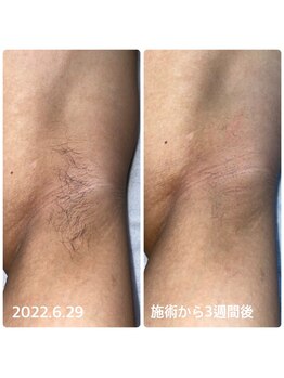 バロン/部分脱毛効果1