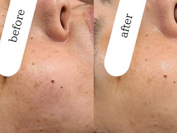 ブラン(BLANC)/【ヒト幹細胞美容】50％濃度導入