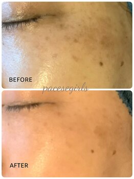 パーチェスガールズ 姪浜店(Pace-se Girls)/シミケア