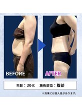 縁(en)/脂肪冷却＊ビフォーアフター