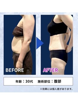 縁(en)/脂肪冷却＊ビフォーアフター