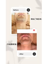 ユメバンチ(yumebanchi)/ヒゲ脱毛