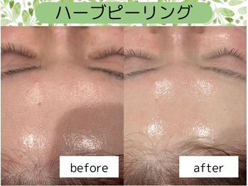 ウルル 金山駅前店(ULULU)/ハーブピーリング