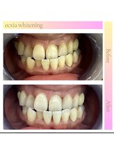 エクシアホワイトニング 草津店/ホワイトニングビフォーアフター