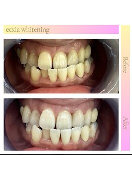 エクシアホワイトニング 草津店/ホワイトニングビフォーアフター