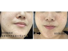 メディカルサロンドオフ 堺東店(medical salon de off)/LEZE(ルゼ)カクテルピーリング