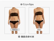 クリオスパ せんげん台駅前店(Cryo Spa)/脂肪冷却Before/After
