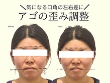 REGISTA ボディ&フェイシャルケアサロン/筋膜リリース/小顔矯正/実例！小顔矯正