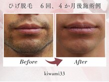 キワミ サーティスリー(kiwami33)/スルスル抜けるハイパワー脱毛