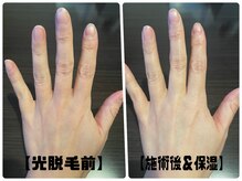 トータルビューティーサロン デザイン/保湿ケア/RF効果について