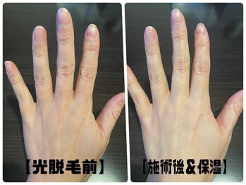 トータルビューティーサロン デザイン/保湿ケア/RF効果について