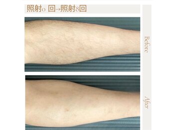 マオ(mao)/全身脱毛(顔・vio込)