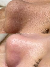 ゴールド 恵比寿店(GOLD)/【毛穴エクストラクション】