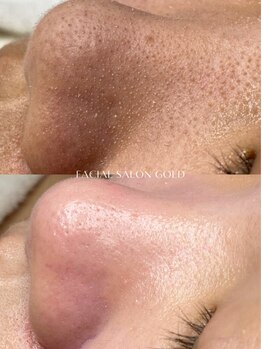 ゴールド 恵比寿店(GOLD)/【毛穴エクストラクション】