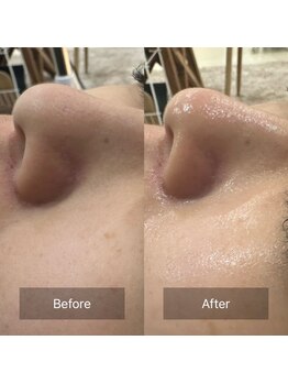 ケアナ 梅田店(CareNa)/ツヤ肌毛穴洗浄★ヒト由来幹細胞